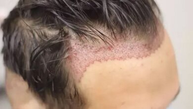 Transplantasi Rambut